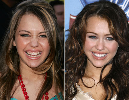 miley_cyrus_Veneers
